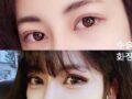 뒤트임 후기 ^0^