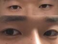 남자눈성형후기