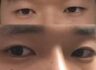 남자눈성형후기